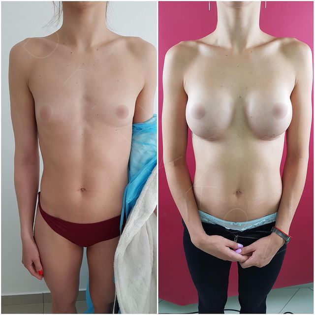 295 cc Polytech teardrop breast implants, 2 months post-op