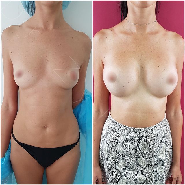 320 cc teardrop Polytech, 3 months post-op