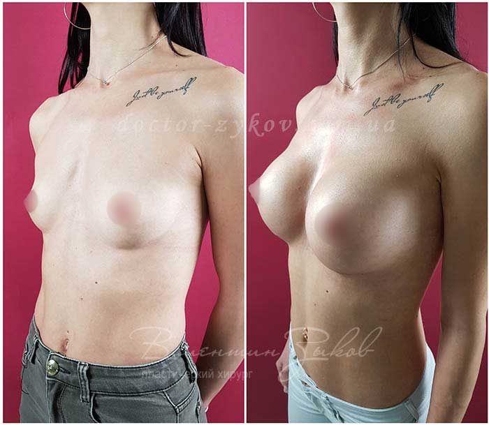 350 cc Polytech polyurethane teardrop-shaped implants under the muscle, 20 days post-op