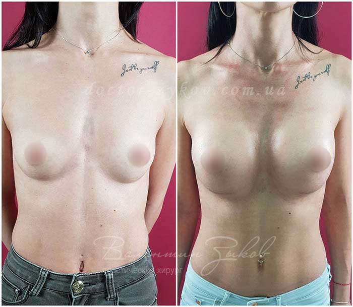 350 cc Polytech polyurethane teardrop-shaped implants under the muscle, 20 days post-op. The submarine fold fell 3 cm