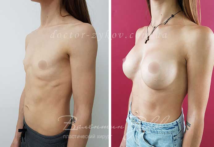 350 cc Polytech drop-shaped implants, 8 months post-op