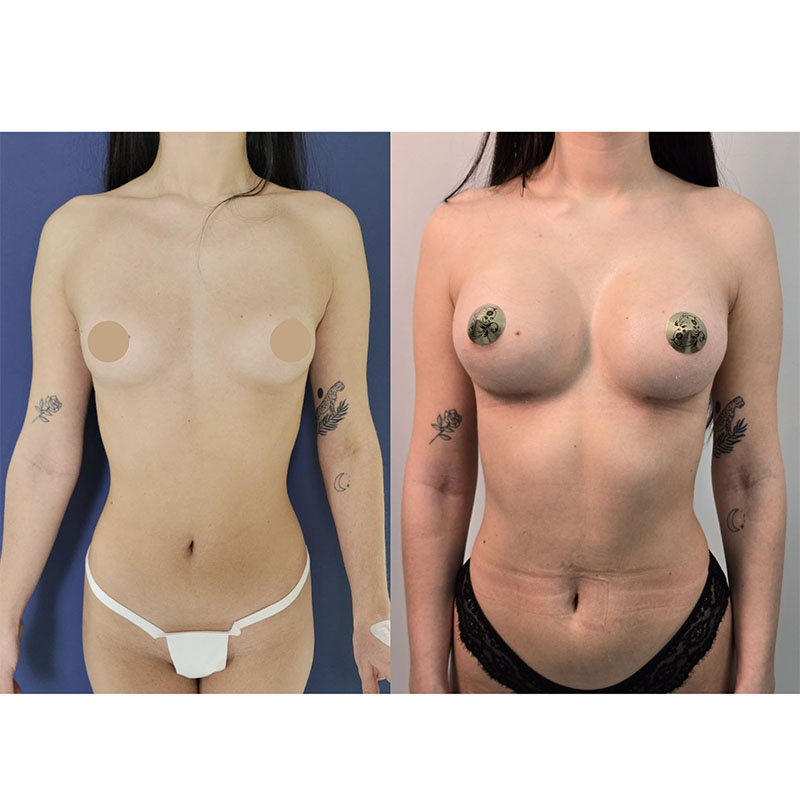Result after mammoplasty. Anatomical implant 315 ml