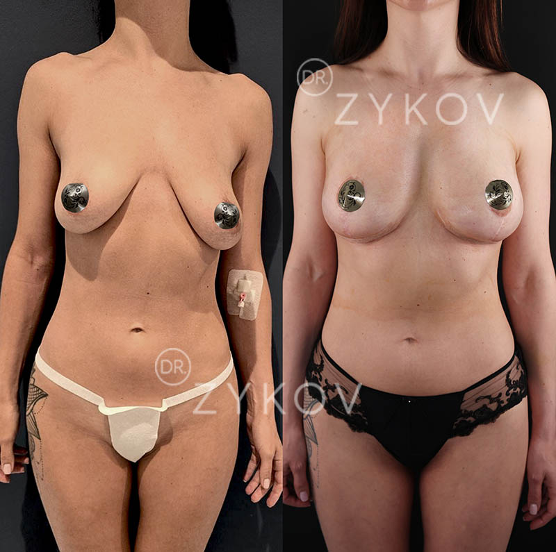 Breast lift with 245ml round implants under the muscle