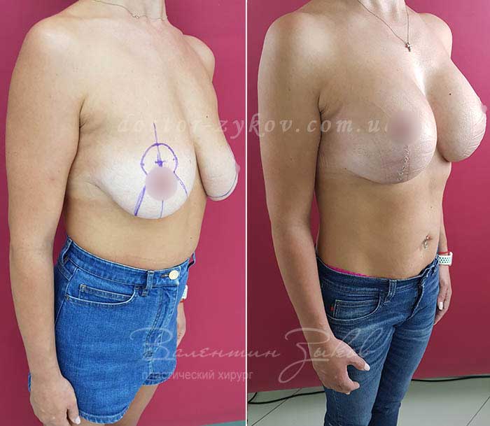 Lollipop Breast Lift with round implants Mentor, 3 weeks post-op. Glue is on the seams