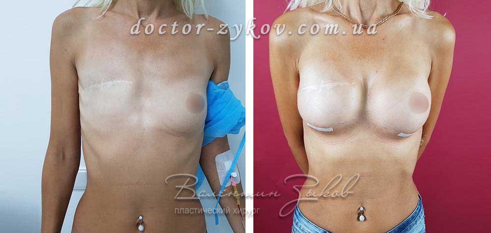 Breast reconstruction with implants of different sizes (anatomical Polytech polyurethane), 20 days post-op
