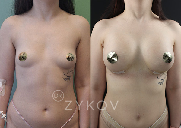 350 cc (microtexture). Teardrop shape. Day 4 post-op