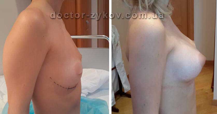 Breast augmentation with round implants under the muscle - before and after