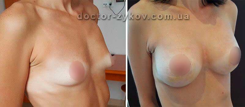 Breast augmentation with a round implant 400 cc through the areola, 12 days post-op. Complex case - tubular breast