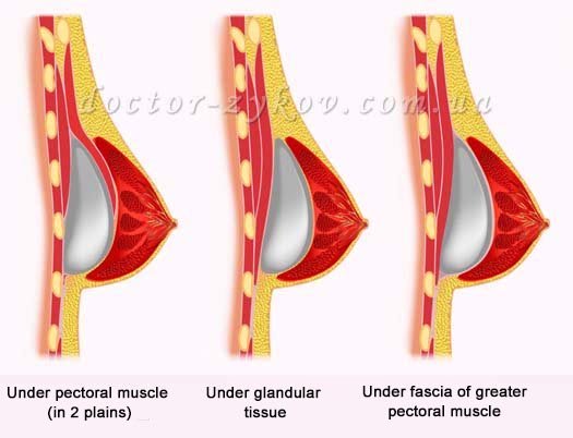 Options for installing breast implants