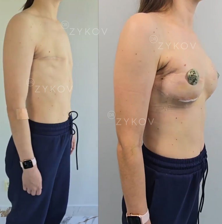 Simultaneous placement of anatomical implants after total mastectomy without using expanders