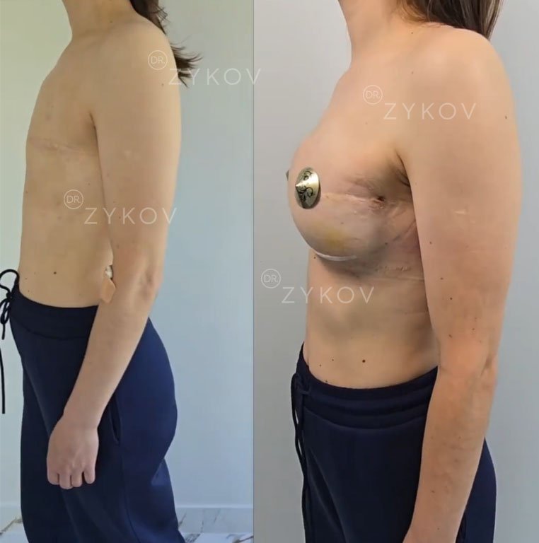 Simultaneous placement of anatomical implants after total mastectomy without using expanders