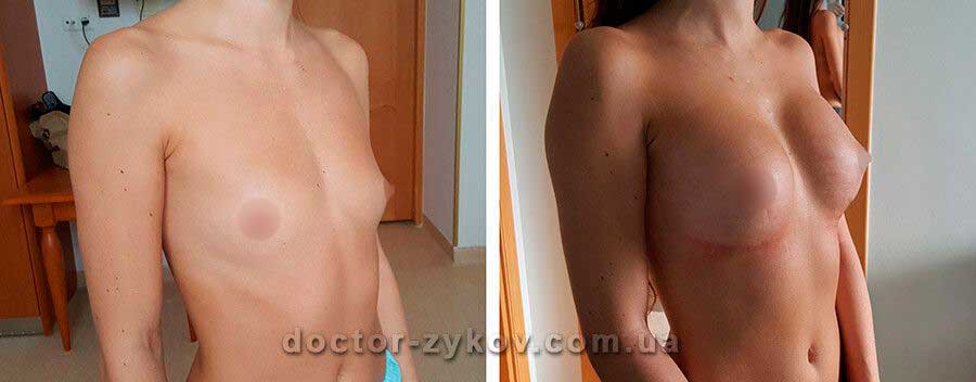 Mammoplasty with round implant Polytech 360 cc, under the muscle. 12 day post-op