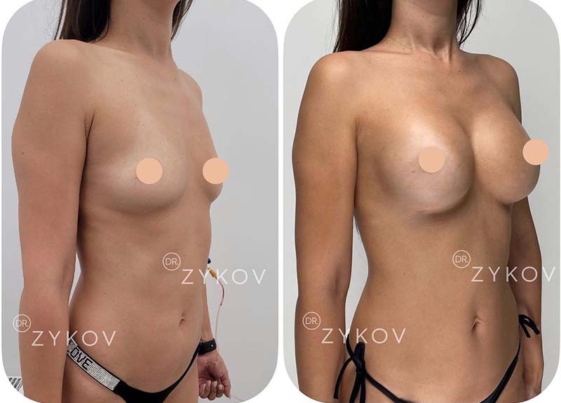 Anatomical breast implants Polytech 350 ml 2 months post-op