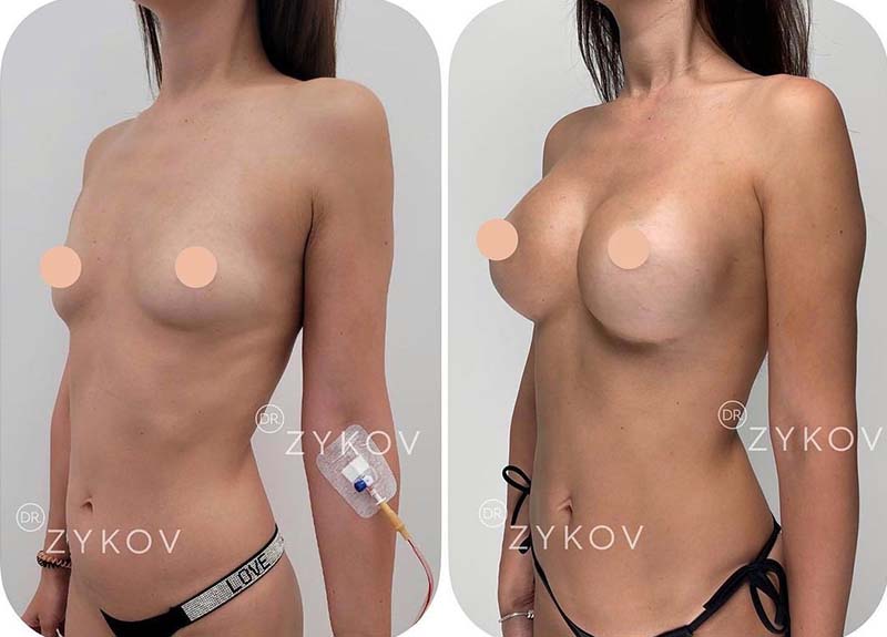 Anatomical breast implants Polytech 350 ml 2 months post-op