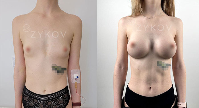 Motiva anatomical true fixation shortened implants 285 ml. 2 months post-op