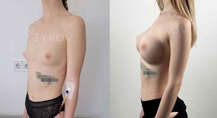 Motiva anatomical true fixation shortened implants 285 ml. 2 months post-op