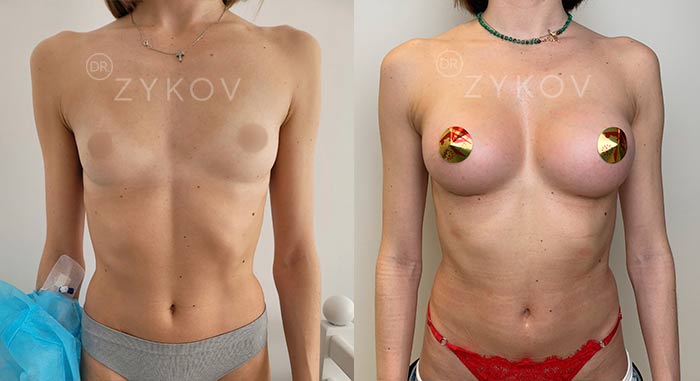 Drop-shaped implants Motiva, 330 ml. 2 months post-op