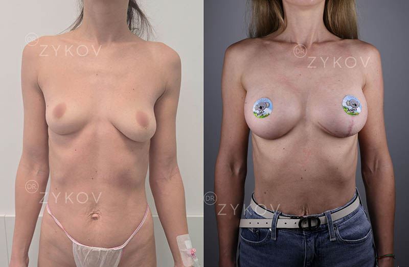 Motiva Ergonomix 310 ml, low profile + one-sided breast lift. 3 months post-op