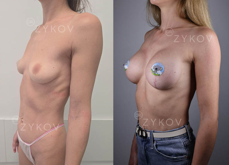 Motiva Ergonomix 310 ml, low profile + one-sided breast lift. 3 months post-op