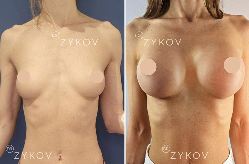 Motiva Ergonomix 2 под мышцу 380 мл. Через 1 месяц