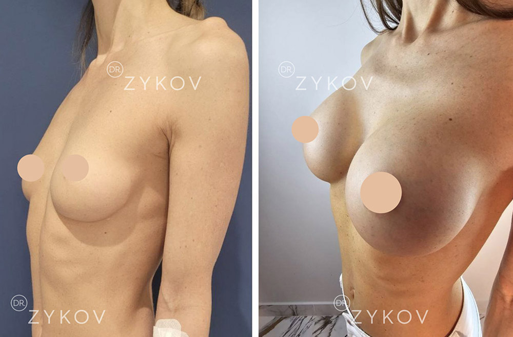 Motiva Ergonomix 2 под мышцу 380 мл. Через 1 месяц