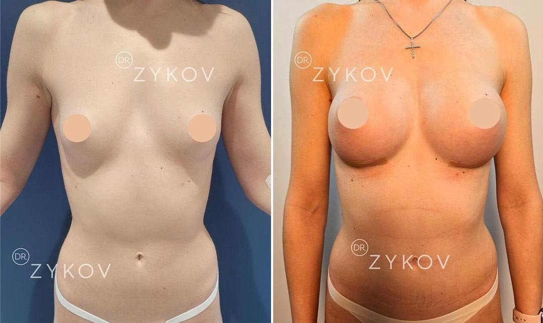 Motiva Anatomical True Fixation 285 ml after 1 month