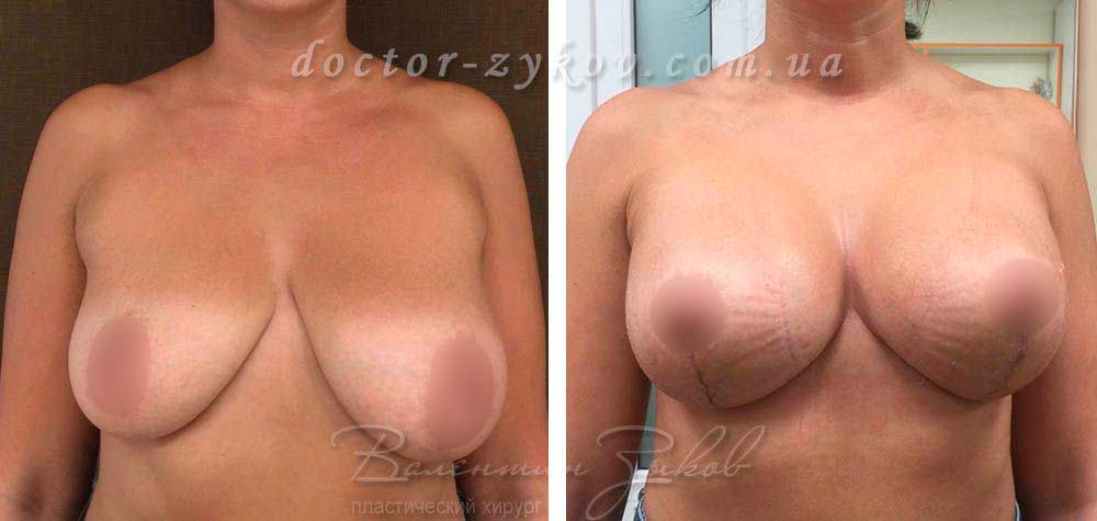 Beast lift with round implants Allergan 275 cc, 3 weeks post-op. Before and after photo