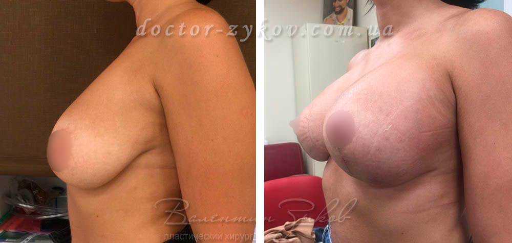 Beast lift with round implants Allergan 275 cc, 3 weeks post-op. Before and after photo