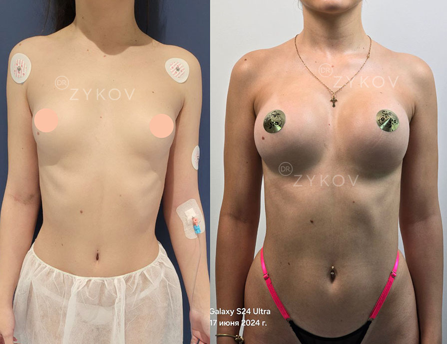 Polytech implants, drop-shaped, size 315 ml. 3 monthes post-op