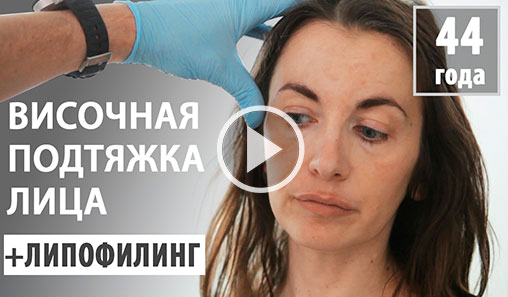 Темпоральний фейсліфтінг + ліпофілінг до і через 1,5 години після операції височная подтяжка лица и липофилинг - видео